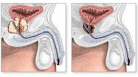 Chirurgico prima e dopo il trattamento della prostatite cronica