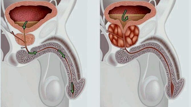 prostata sana e infiammata con prostatite