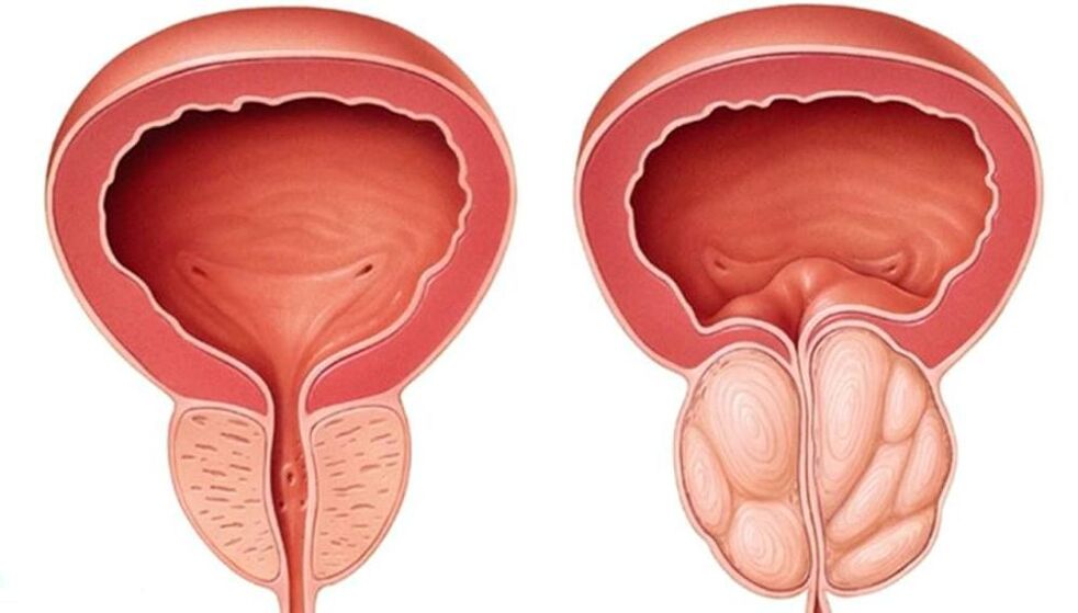 prostata normale e ingrossata