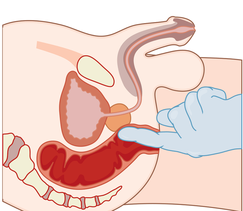 Massaggio alla prostata con prostatite